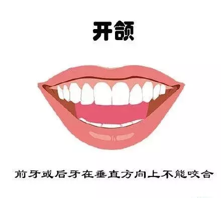 什么牙需要矫正呢？