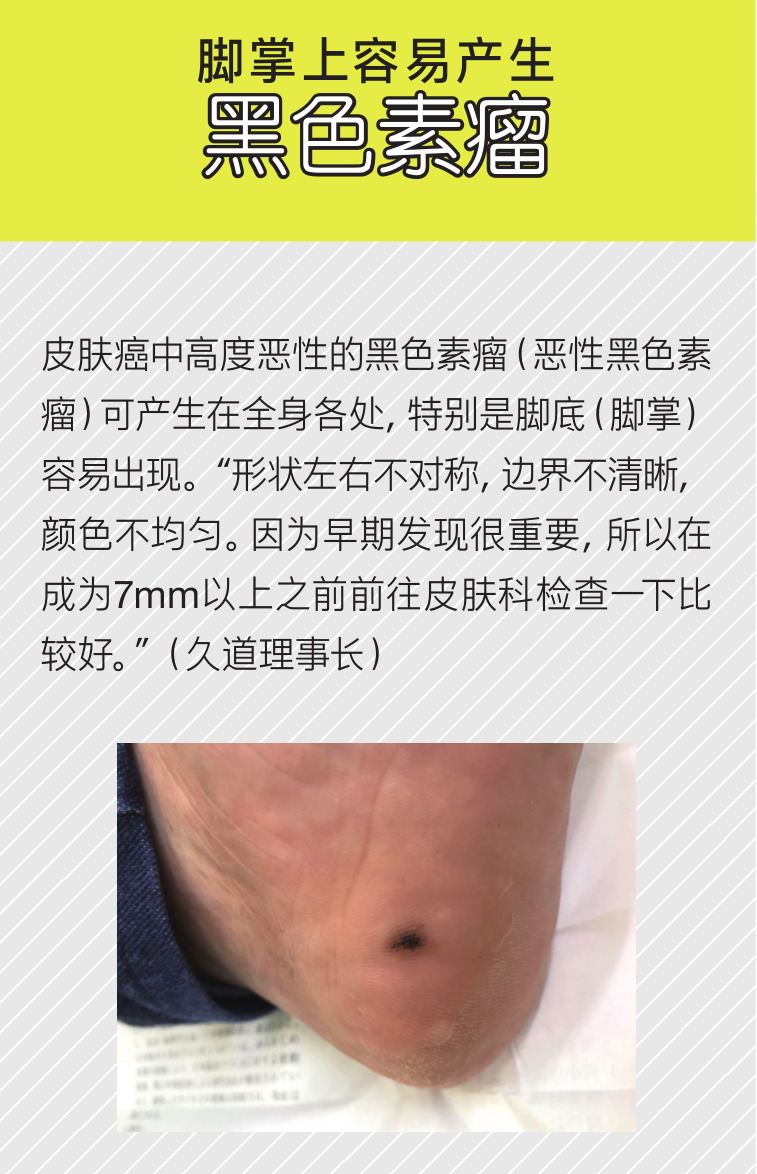 硬邦邦的老茧 会痛的鸡眼 日本皮肤科专家教你矫正足部恶习 健康与美容 Mdeditor