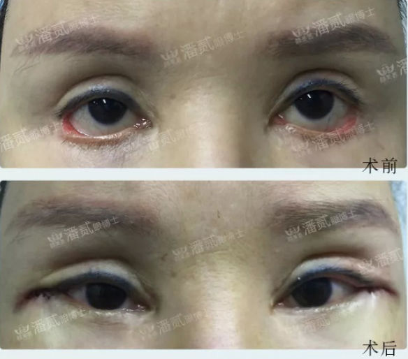 下三白眼科普:下瞼下至注意分寸!別過度醫療,錯把病態當美態 - 資訊咖