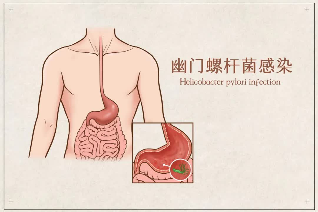 没有症状也有治疗！幽门螺杆菌感染“药”知道