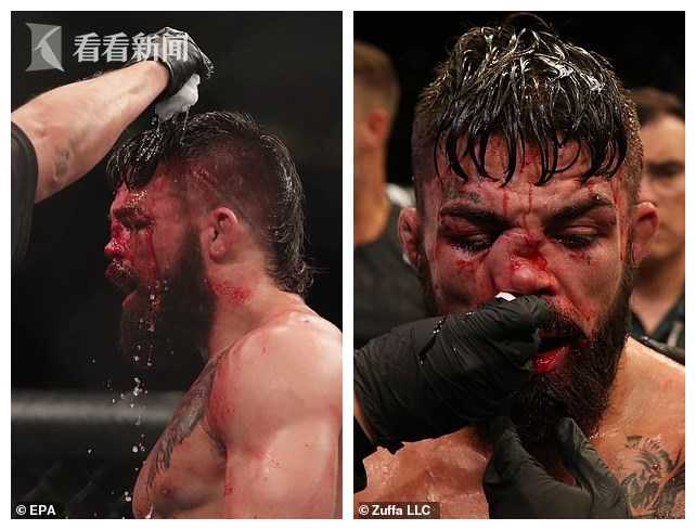 UFC史上鼻子受伤最严重的比赛：被打成S型！5万美元一只鼻子值不值？