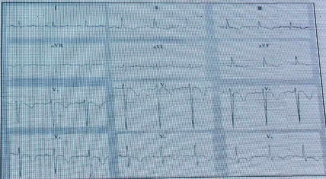 如何从纷繁的ST-T改变中识别高危患者？丨临床解惑