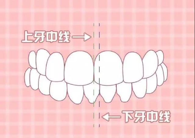 8种要矫正的牙齿畸形，看医前可对照自检