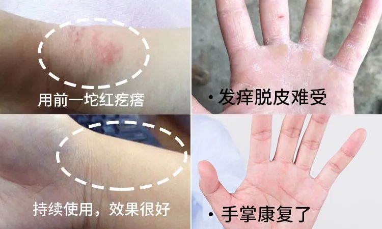 皮肤起胞水泡，奇痒难忍？用它止痒，草本配方，抑菌率99.9%