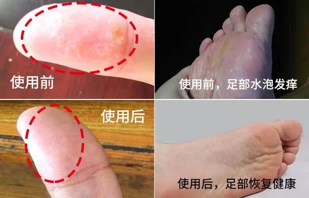 皮肤起胞水泡，奇痒难忍？用它止痒，草本配方，抑菌率99.9%