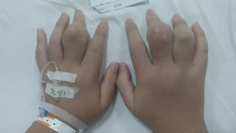 女教师每天一杯奶茶，午休时被送进ICU，抽出来的血都是……