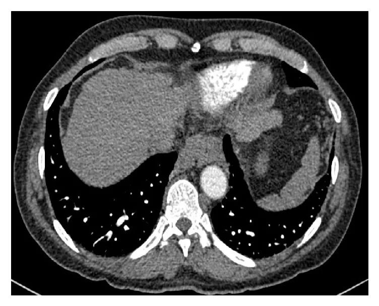 慢性丙肝患者发绀、杵状指，何因所致？｜临床实战
