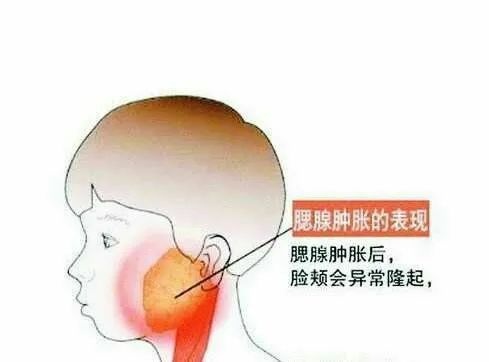 预防措施:1.接种腮腺炎疫苗.2.及早发现,及时隔离直至消肿为止.