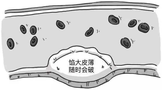 你的血管，就是這樣堵的