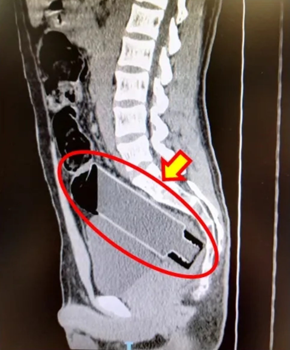 好奇害死猫，小伙子把水瓶塞进直肠，看肛肠科医生这些年取出的异物“从A到Z”有哪些