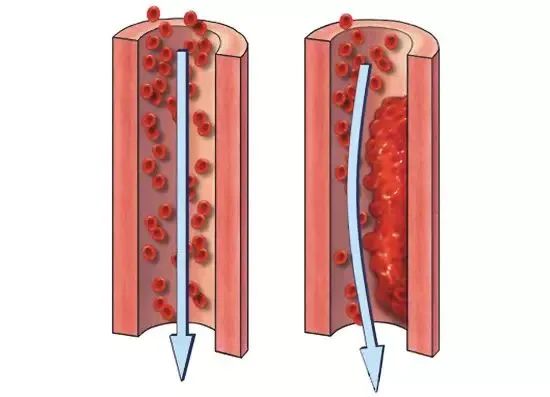 99%的血栓无征兆，这些细节需要注意