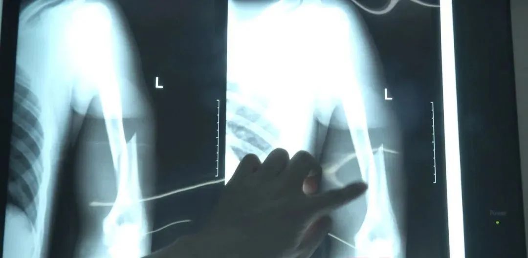 大二男生掰手腕，胳膊断了，医生：指标还不如老年人