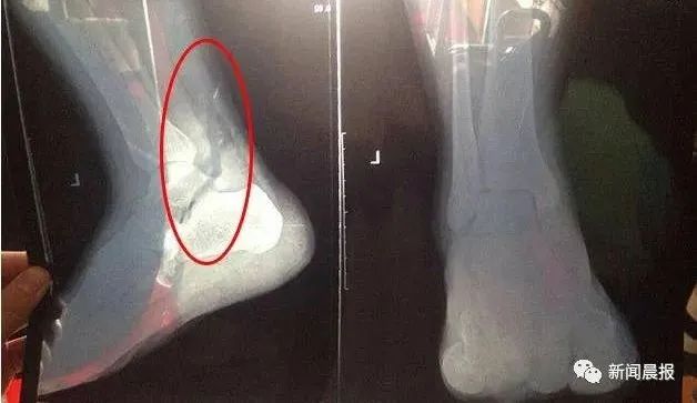 大二男生掰手腕，胳膊断了，医生：指标还不如老年人