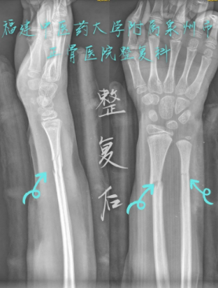 小学生摔伤致骨折错位却不愿手术正处骨骼发育的关键时期 小学生 摔伤 社会资讯 川北在线