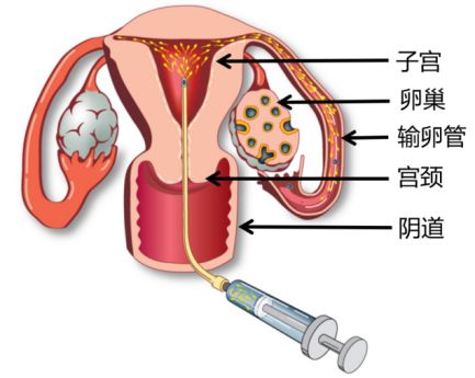 人工授精的成功率有多少？ 什么是人工授精？