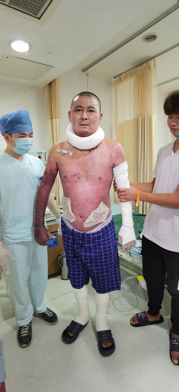 杭州电瓶车爆燃烧伤父女最新环境：父亲出院，女儿仍在抗传染