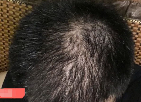 疯狂|24岁小伙疯狂健身后险些秃头 已有多人中招