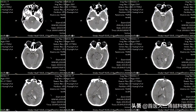 妊娠27周孕妇突发脑出血多学科协作紧急救治 首医大三博脑科医院 Mdeditor