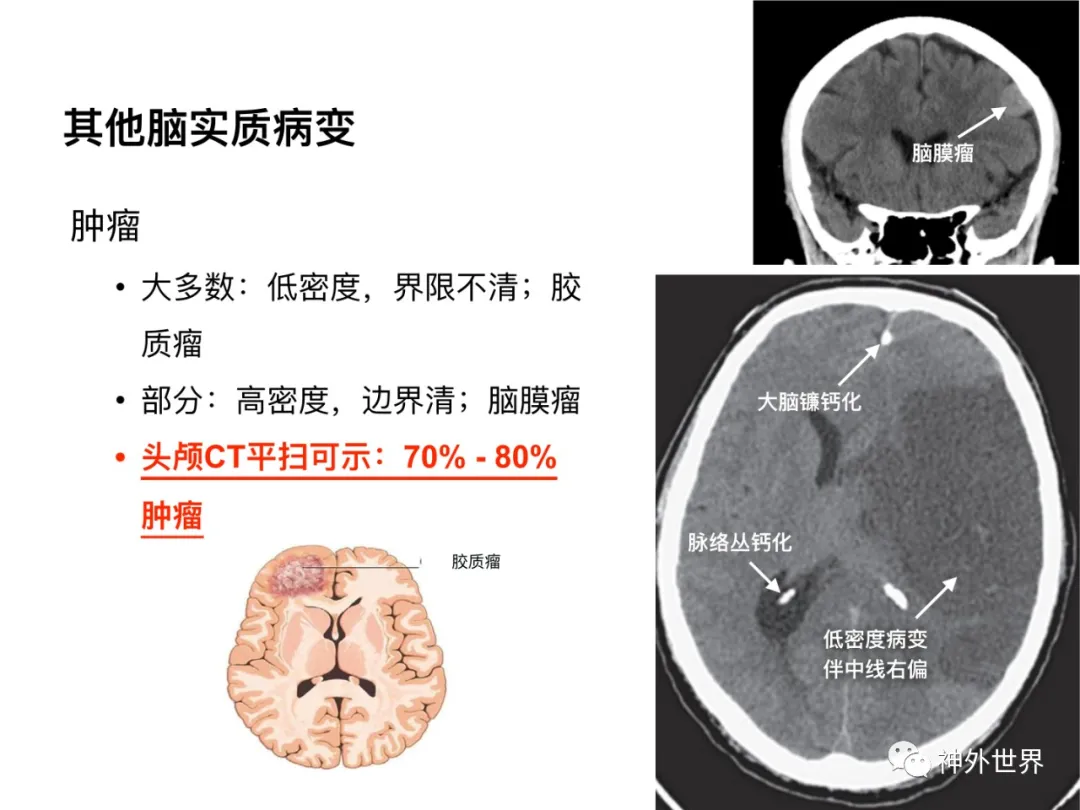 最全影像总结 | 颅内病变 MR、CT 的阅片技巧，太赞了