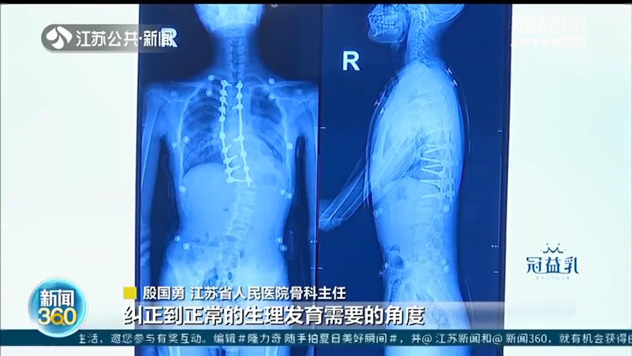 6小时，&ldquo;长高&rdquo;10厘米！一场脊柱重建手术让驼背男孩挺起胸膛