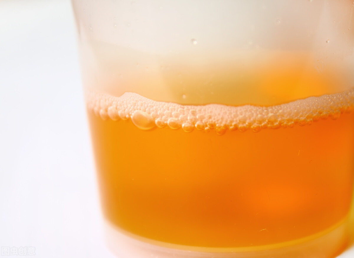 I have bubbles in my urine. Is it kidney disease?Take it easy, not all foamy urine is kidney