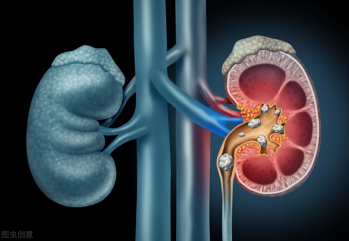 Diabetes foamy urine is sometimes absent, but the kidneys have been ...