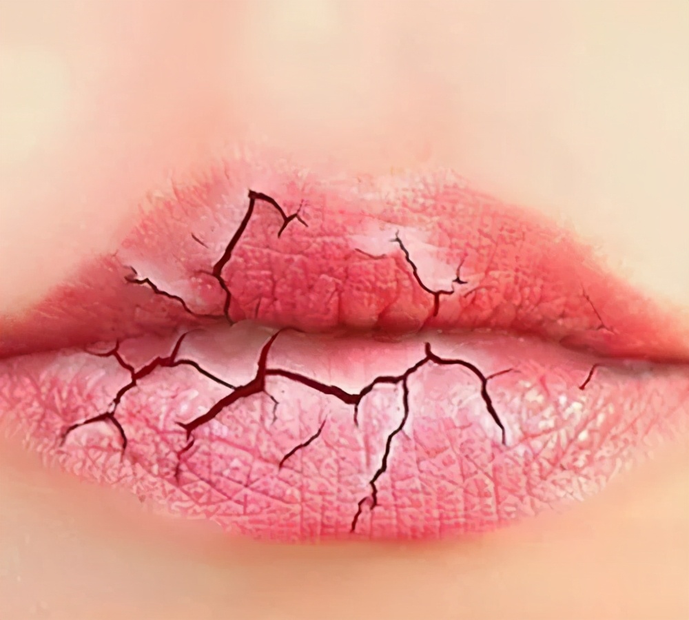 唇炎自救指南丨嘴巴上「唇皮林立」，到底怎么办？