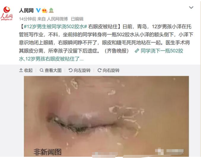 熊孩子將502膠水倒進12歲男孩眼中：別讓別人替你教育孩子