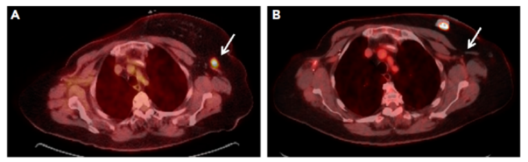 TMB-H患者免疫疗效竟然这么好,总疗效翻4倍！患者直接CR！