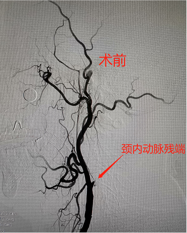 家里老人反复出现言语不利、一侧肢体无力，怎么办？
