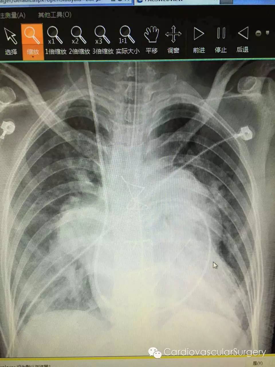 房间隔缺损(8)_房间隔缺损_治疗方式_日常注意事项 - 好大夫在线