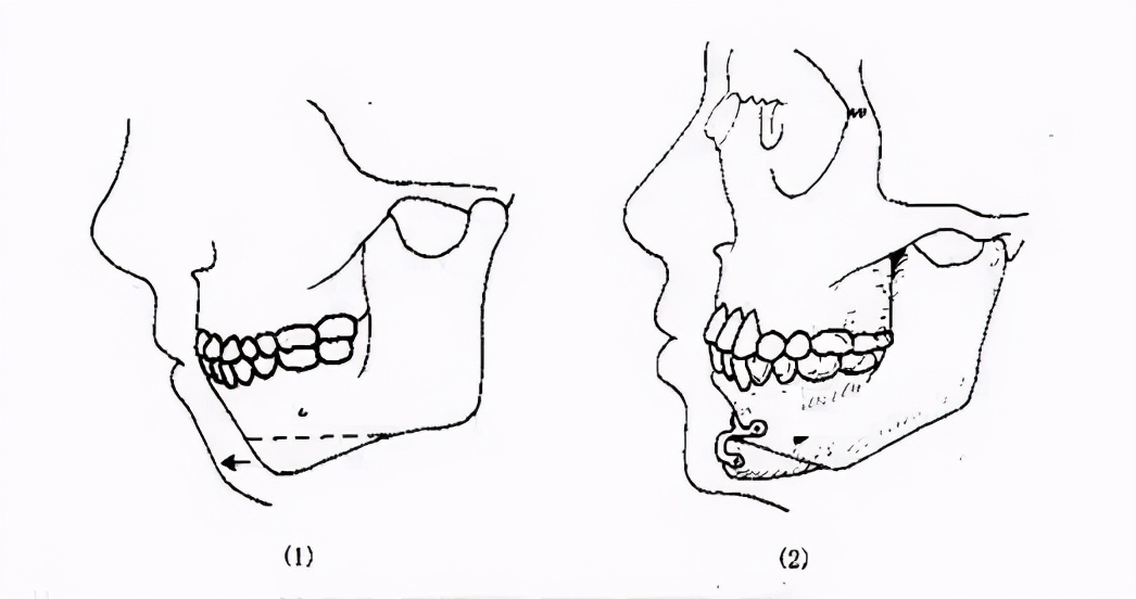 下颌整形_下颌整形治疗介绍 好大夫在线