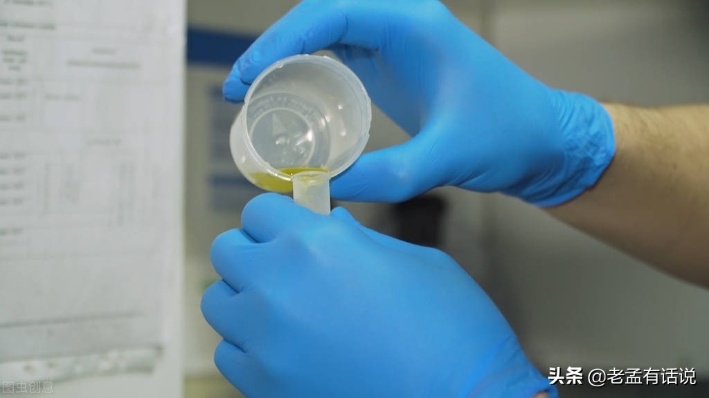 Is foamy urine equal to proteinuria?Does more foam mean more serious