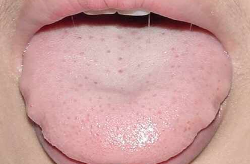 胖大舌的病机和临床表现