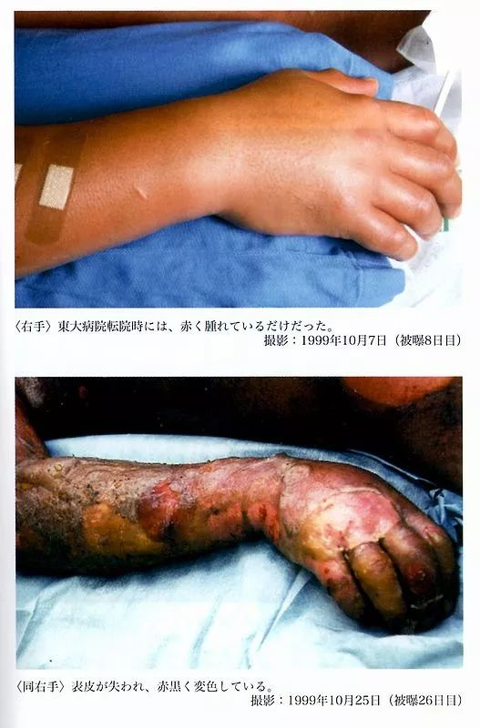 日本嚴重核泄漏事件，被輻射人83天身體腐爛去世