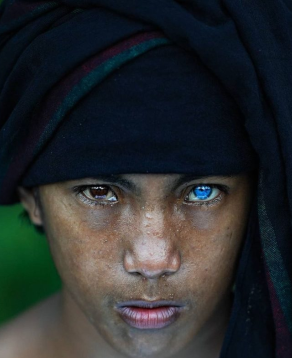 罕见疾病让他们拥有非常特别蓝眼睛说实话有点惊艳啊