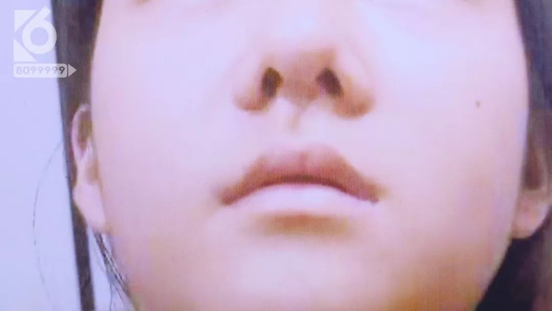 15岁少女执意整形 花11万后整容变毁容