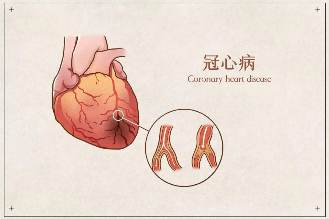 「速效救心丸」冠心病常备良药，正确服法学起来