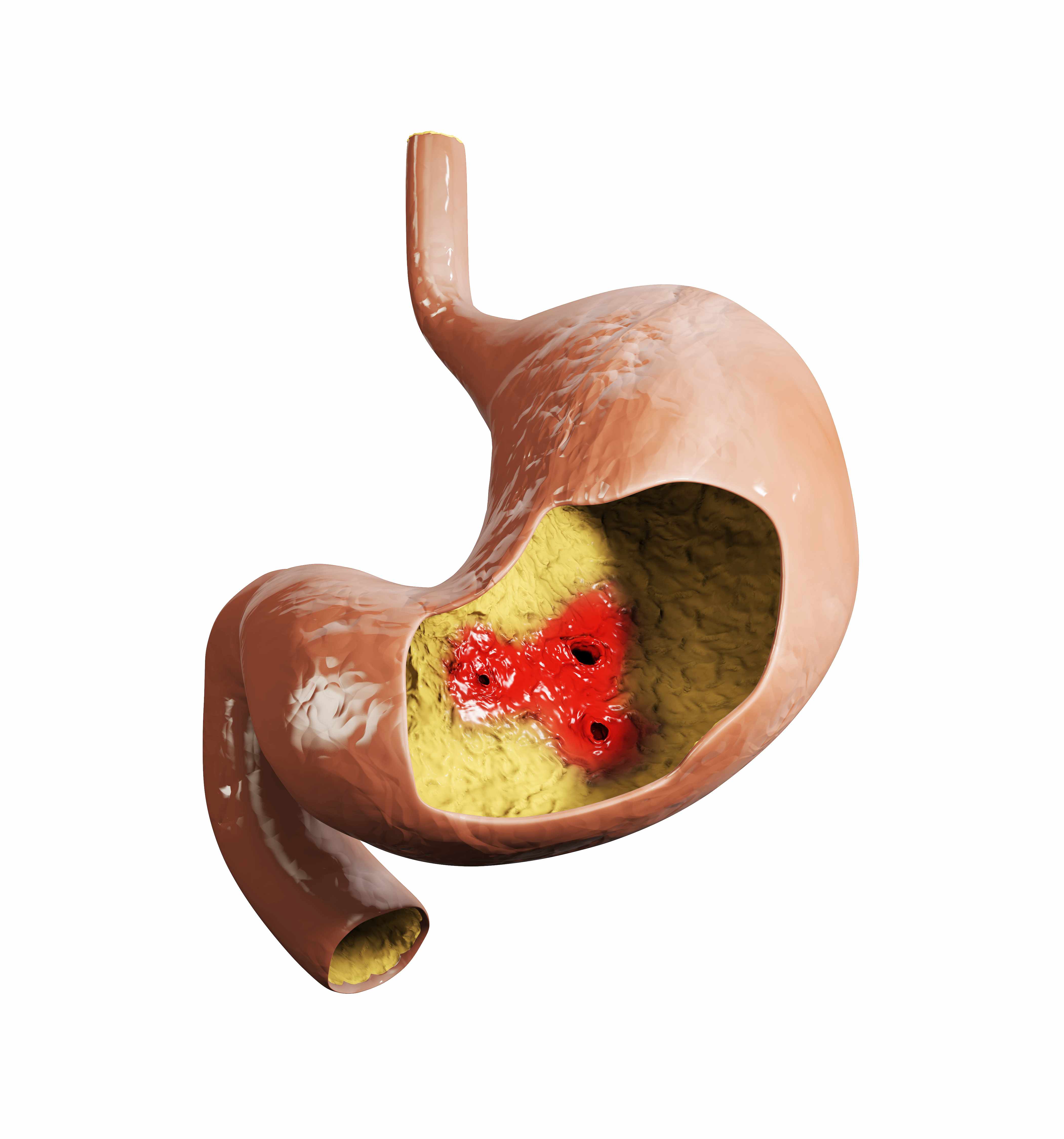 Does the stomach really rot? If erosive gastritis is not treated in ...