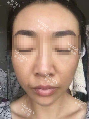 「唯诺雅淡斑反馈」秋季是祛斑的黄金周期