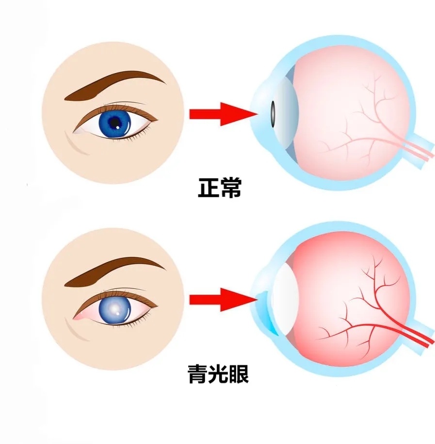 兰州爱尔眼科医院携手“青光侠”项目救助贫困青光眼患者