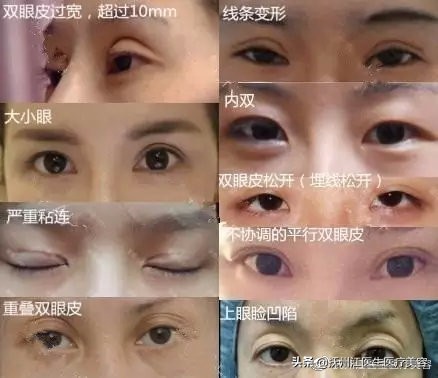 雙眼皮修復的10個常見問題 幫你避免二次手術 撫州江醫生醫療美容 Mdeditor