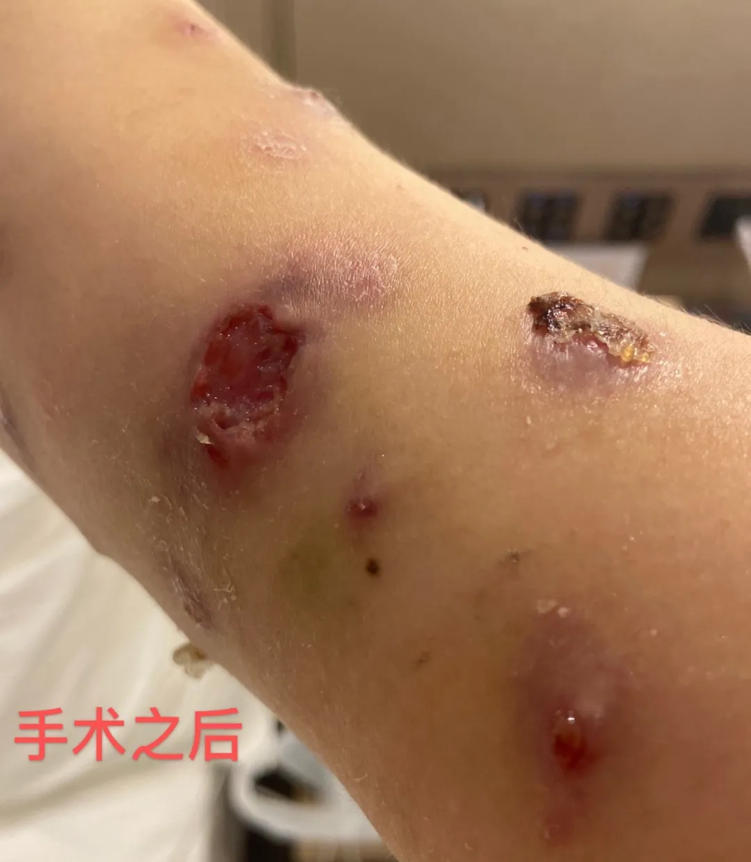 想变瘦却被“千刀万剐”！美女尝试减肥新产品被割成“蜂窝煤”，竟是感染这种细菌