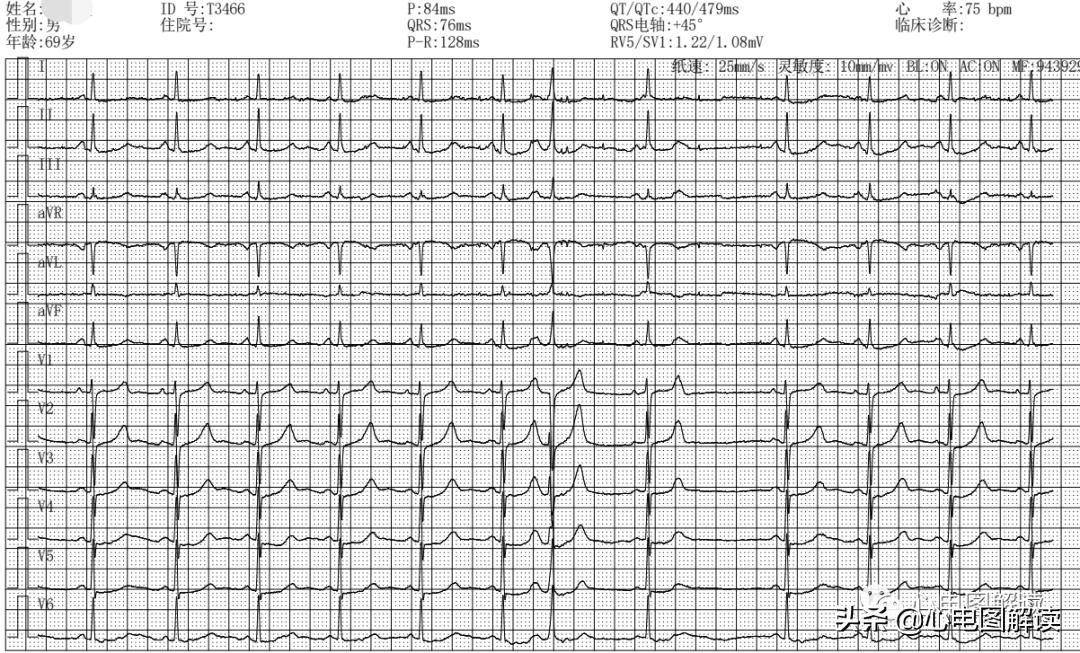 Atrial premature beats?Borderline premature beats?Sinus arrhythmia? - iNEWS