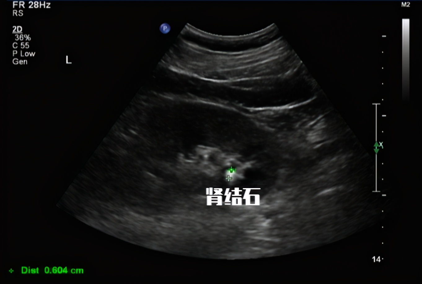 Urinary occult blood 3+ but urinary red blood cells are normal. Is it nephritis?Is there still