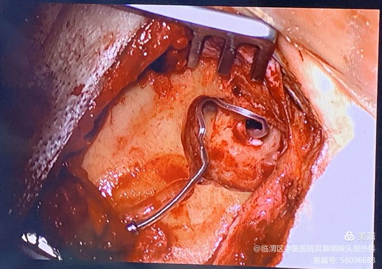 次日,李蕊叶医疗团队对患者进行右耳人工耳蜗植入手术,经过两个小时的