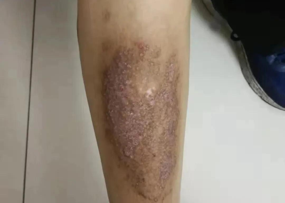 听专科大夫讲如何防治 8种常见的糖尿病性皮肤病 资讯咖