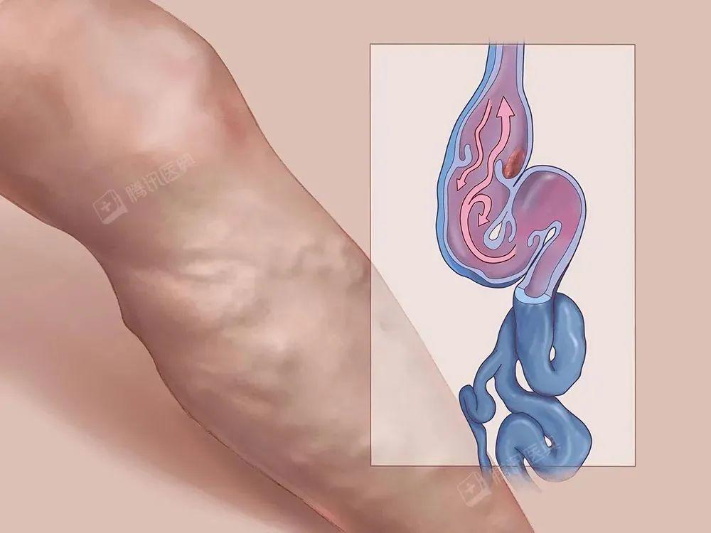 這三類人要注意了，別隨便泡腳！ 不是養生是傷身