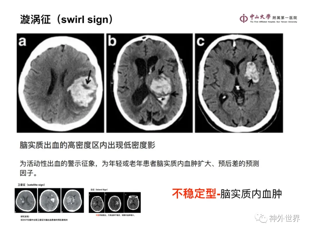 最全影像总结 | 颅内病变 MR、CT 的阅片技巧，太赞了