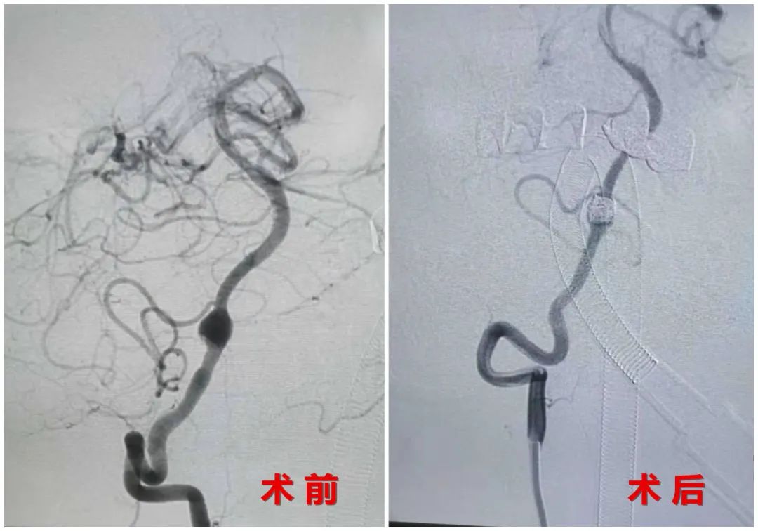 实力+技术，巴彦淖尔市医院成功介入栓塞颅内夹层动脉瘤